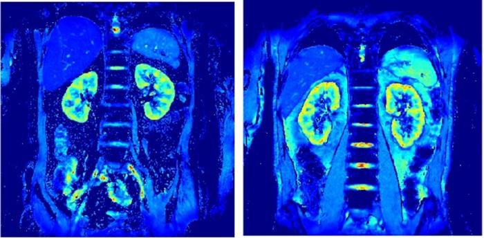 BOLD MRI focusing on the kidneys