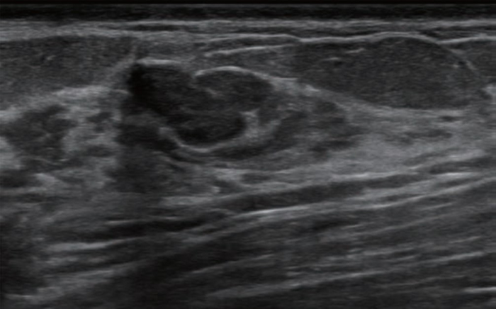 52-year-old woman who underwent prior breast ultrasound due to MRI abnormality, which showed suspicious breast lesion measuring 1.3 cm.