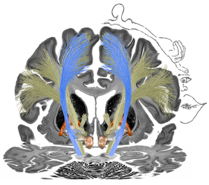 Deep brain stimulation in patients with dystonia