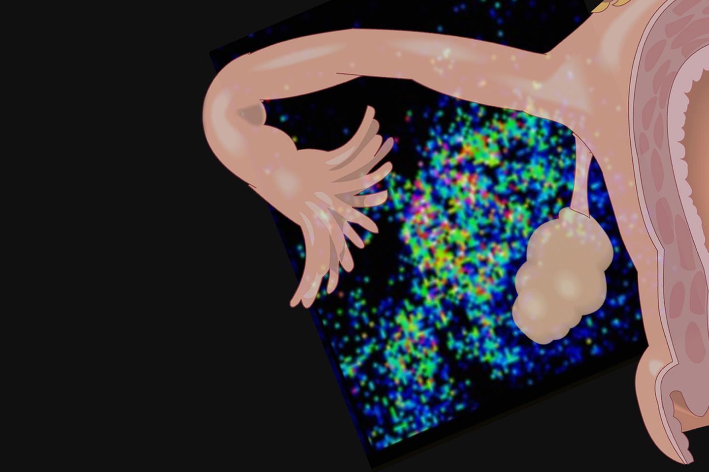 Norepinephrine Levels Increase Around the Ovary in the Presence of Fallopian Tube-Derived Cancer Cel