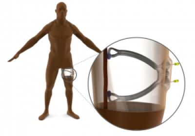 Dialysis Device Illustration (1 of 2)