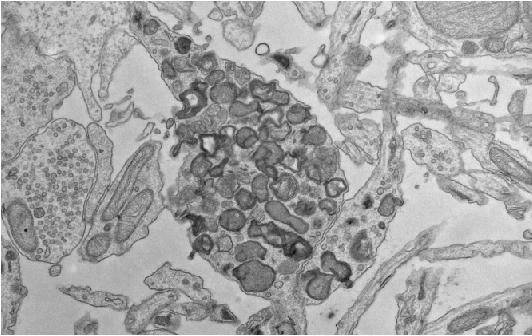 JIP3 Loss Induces Axonal Swellings Filled with Lysosomes