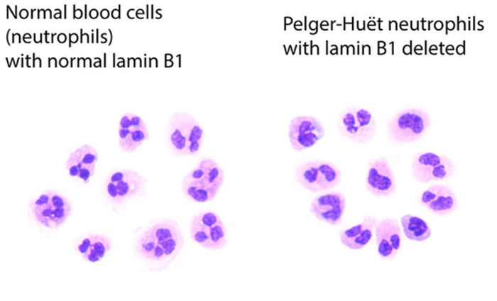 Blood cells with abnormal nuclei