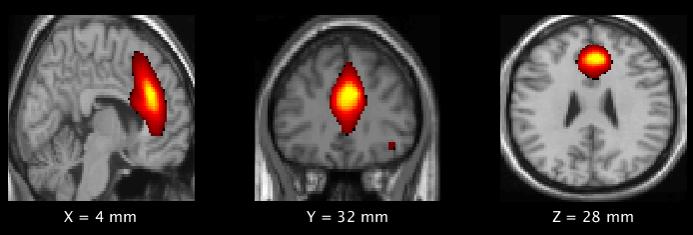 Images Shows Significant Difference between the High and Low Impact Youth Football Players