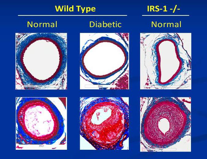 Heart Arteries IRS-1