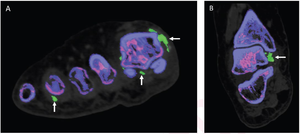 83-Year-Old Woman With No History of Gout and Serum Uric Level of 9.2 mg/dl, Who Underwent DECT (2013) of Right Foot Due to Right Ankle Pain and Swelling