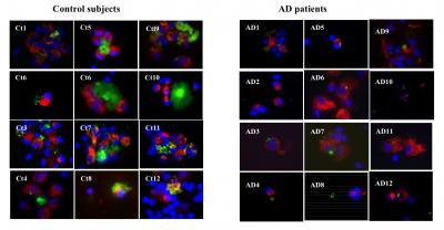 Immune Cells Absorbing Amyloid Beta