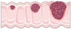 Cancers of the digestive system are on the rise globally