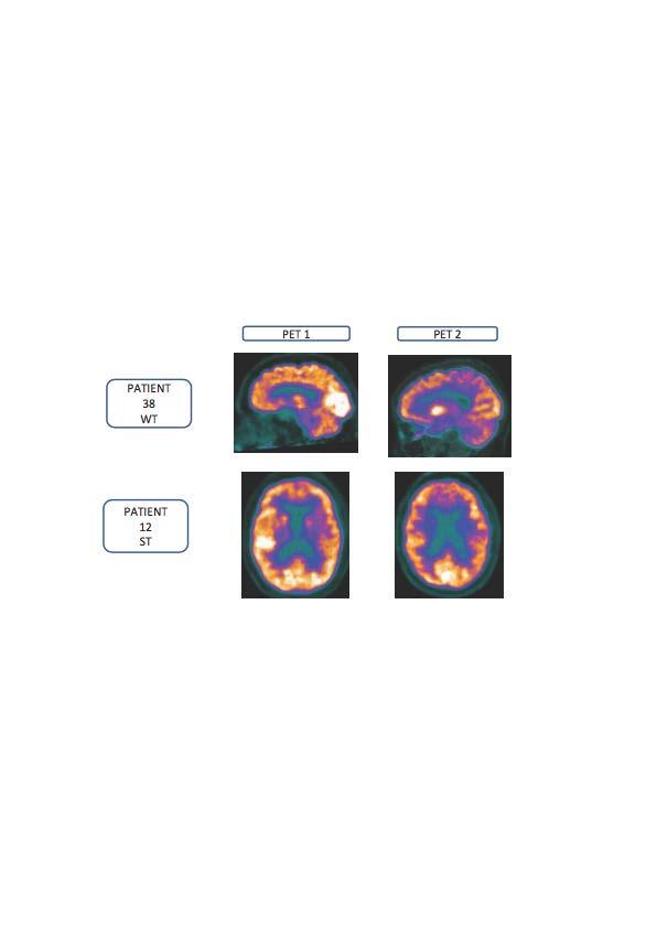 18F-FGD-PET Scans of Two Patients