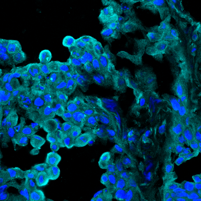 ART1 expression in tumor tissue from a lung cancer patient