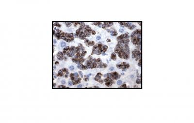 Blood Smear of Leukemic Cells