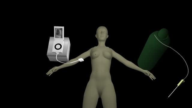 Animation of Carbon Dioxide-Powered Cryotherapy