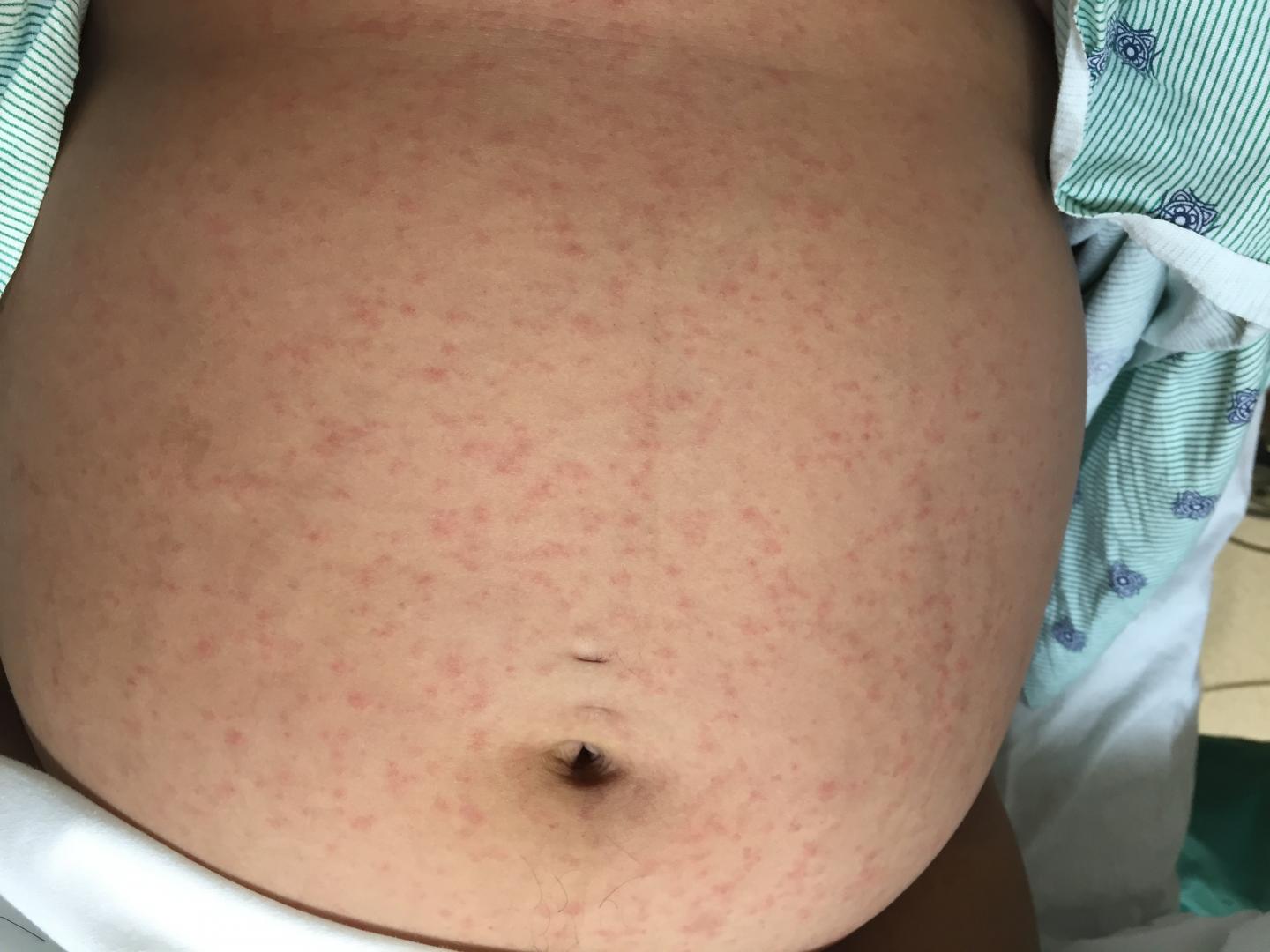 Physicians Publish Case Study of First Locally Acquired Zika Infection (1 of 2)