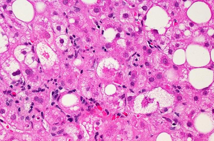 Liver Tissue Affected by Non-Alcoholic Fatty Liver Disease(NAFLD)
