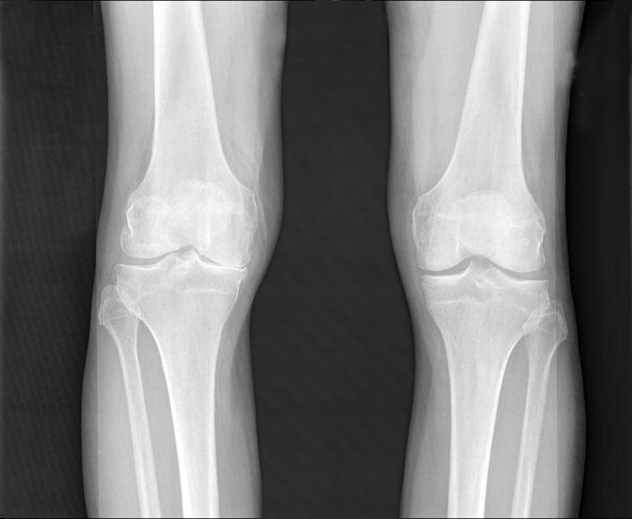 X-ray Image of Osteoarthritic Knees