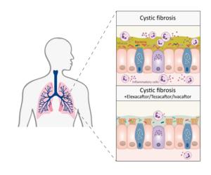 Combination therapy involving three drugs – elexacaftor, tezacaftor, and ivacaftor