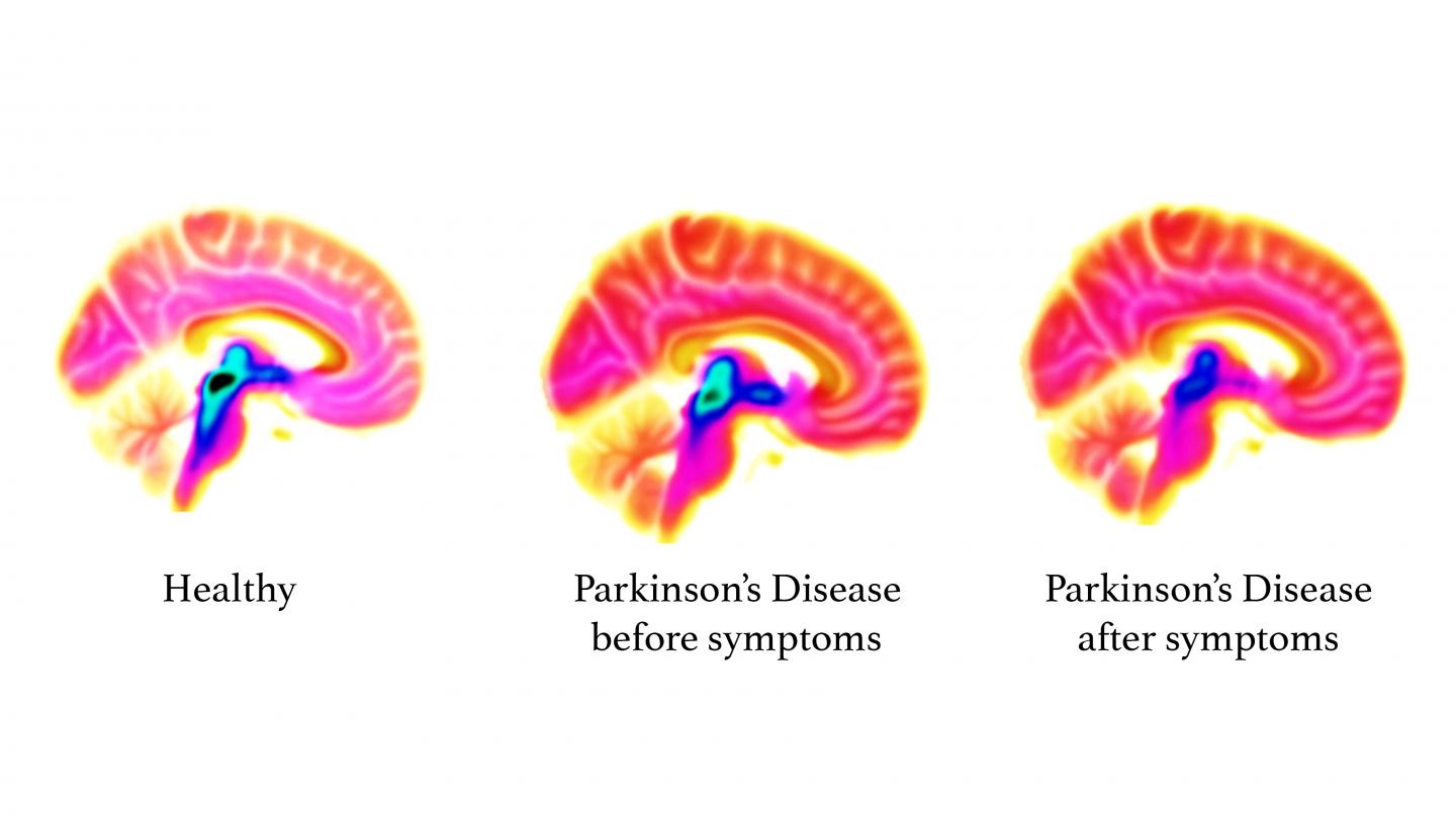 Progression of Parkinson's Disease in Brain (White Background)