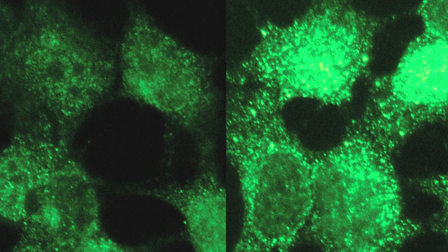 Pediatric Neuroblastoma