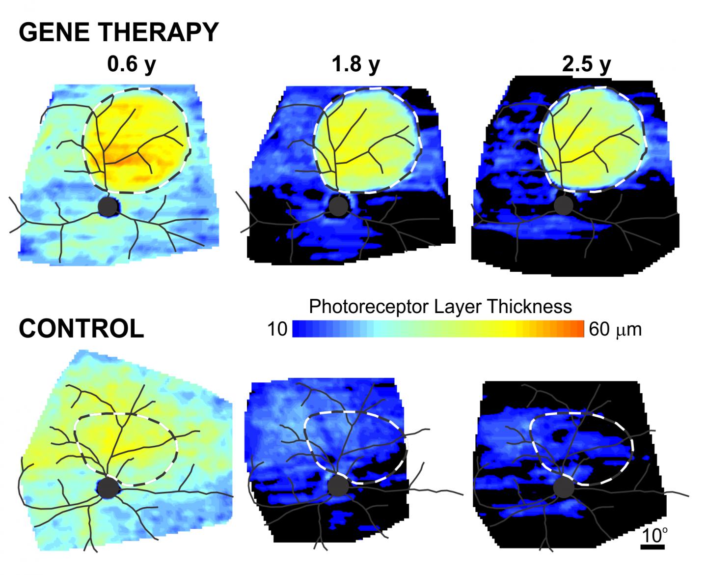 Gene Therapy for X-Linked Retinitis Pigmentosa