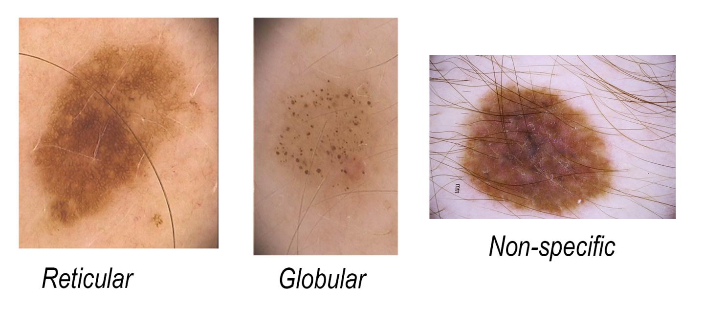 Mole Classification