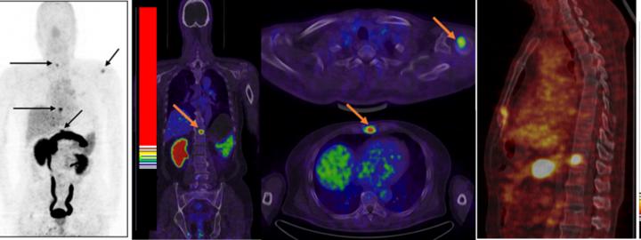 New type of PET imaging identifies primary an