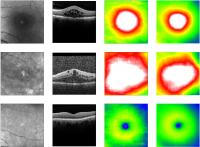 Algorithm predicts retinal thickness