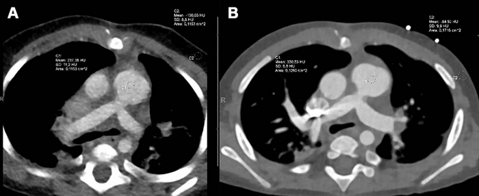 Imaging in Babies with Heart Defects