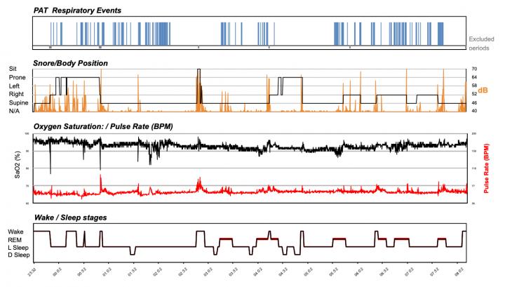 Disrupted Sleep Is Linked to Increased Risk of Death, Particularly in Women
