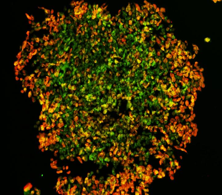 A Melanoma Tumor Generated in the Laboratory by a QUT-led Research Team
