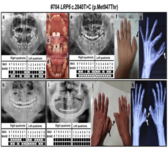 Figure 1. Clinical features and pedigree of families with tooth agenesis caused by LRP6 mutations