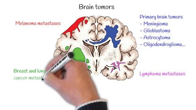 How Does Solid Stress from Brain Tumors Damage Healthy Tissue?