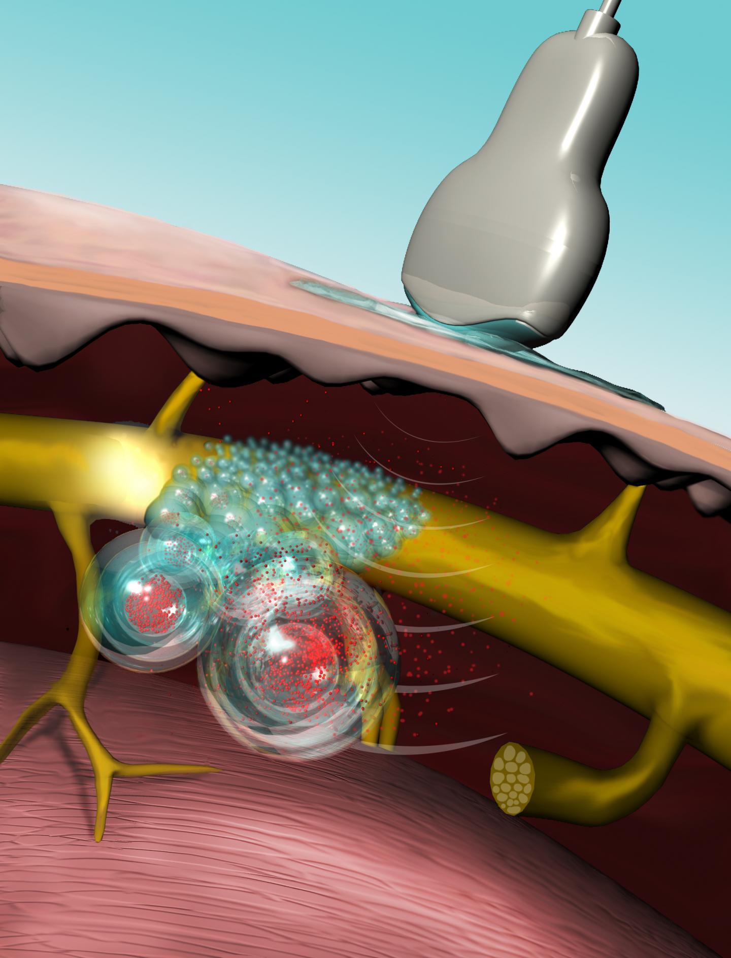 Ultrasound Triggers Liposomes