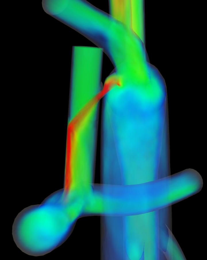Computer Simulation of an Assisted Bi-directional Glenn