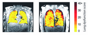 Lung function MRI showing measurements in lung transplant recipients