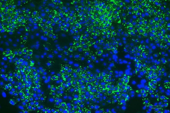 Accumulation of LDL cholesterol in liver cells