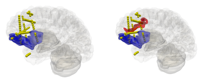 Detection of Epileptogenic Zones