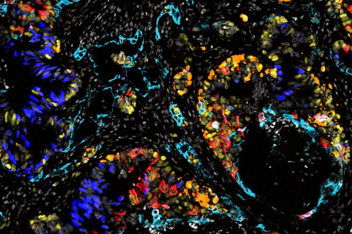 Colorectal Cancer Liver Metastasis