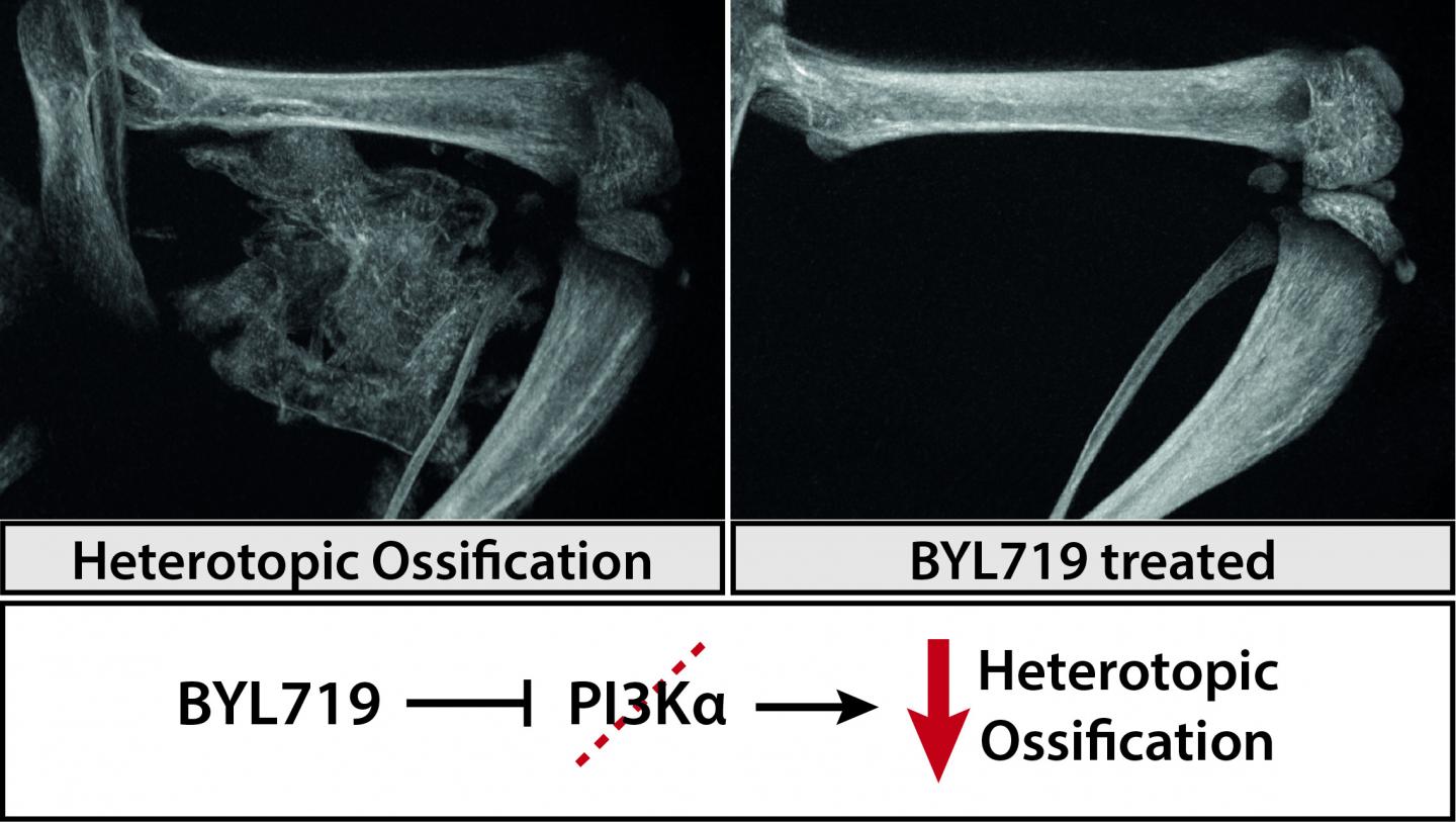 Heterotopic Ossification Treatment