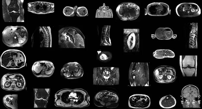 AI Model Automatically Segments MRI Images