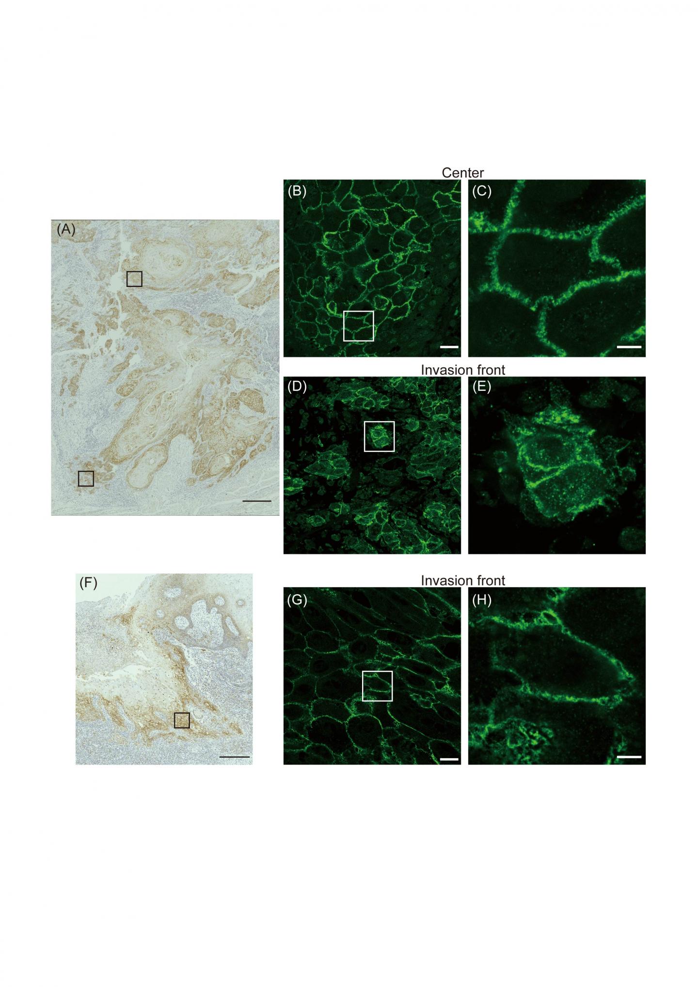 Typical cases of TSCC revealing either the intracellular or membrane-confined localization of claudin-1 at the invasion front.