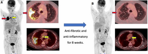 PET/CT to Evaluate and Monitor Post-COVID-19 Lung Disease