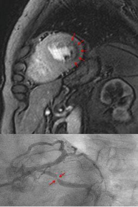 Measuring Blood Flow in the Myocardium with Magnet Resonance Imaging