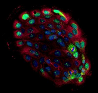 Disturbed Planar Cell Polarity Proteins