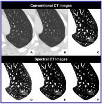 Comparison of Conventional CT Images With Spectral CT Images