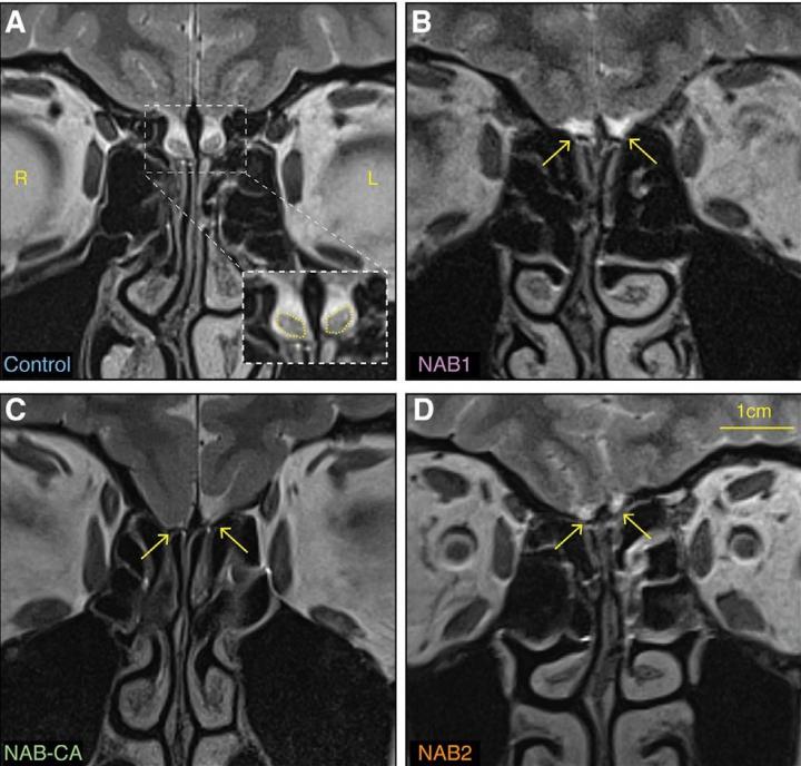 Scan of a Person with Olfactory Bulbs and Scans of People without Olfactory Bulbs