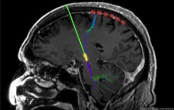 Deep Brain Stimulation Device for Parkinson's Patient