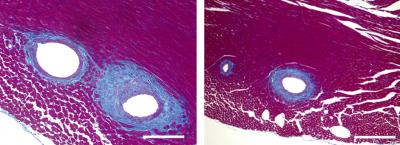 Minimizing Cardiac Fibrosis