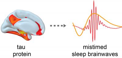 Tau Tangles Led to Disruption of Sleep Rhythms