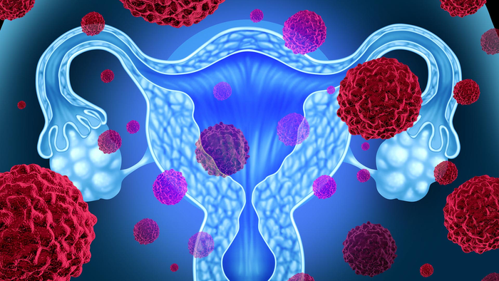 Uterine cancer illustration