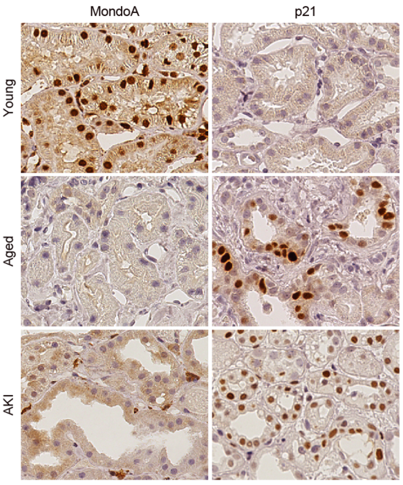 Fig. 2 MondoA counteracts cellular senescence in aging and ischemic AKI in humans